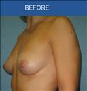 Breast Implants - عيادة سيركاميد