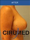 Breast Lift - عيادة سيركاميد