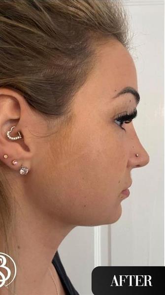 Double Chin - Vaser Liposuction - Ultrasonic Rhinoplasty