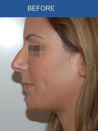 Rhinoplasty